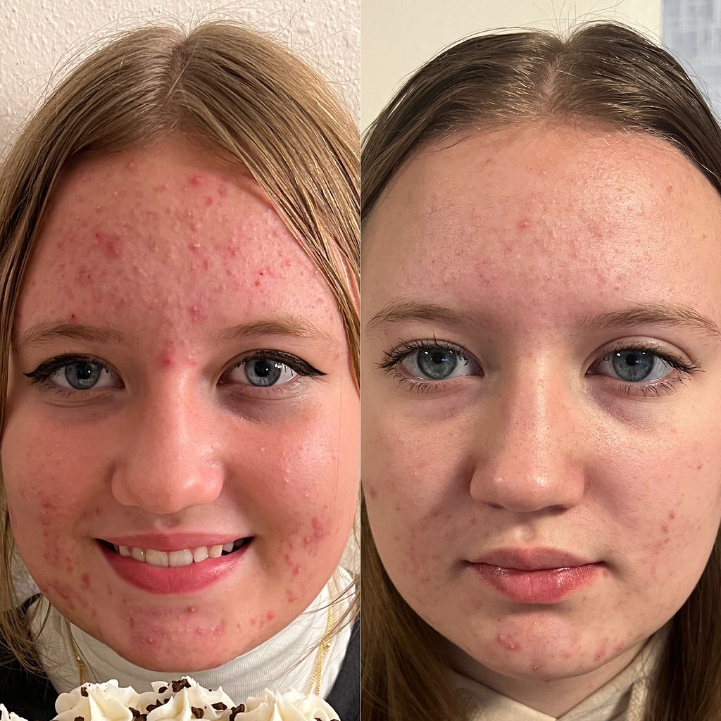Microneedling Acne Scars Before and After