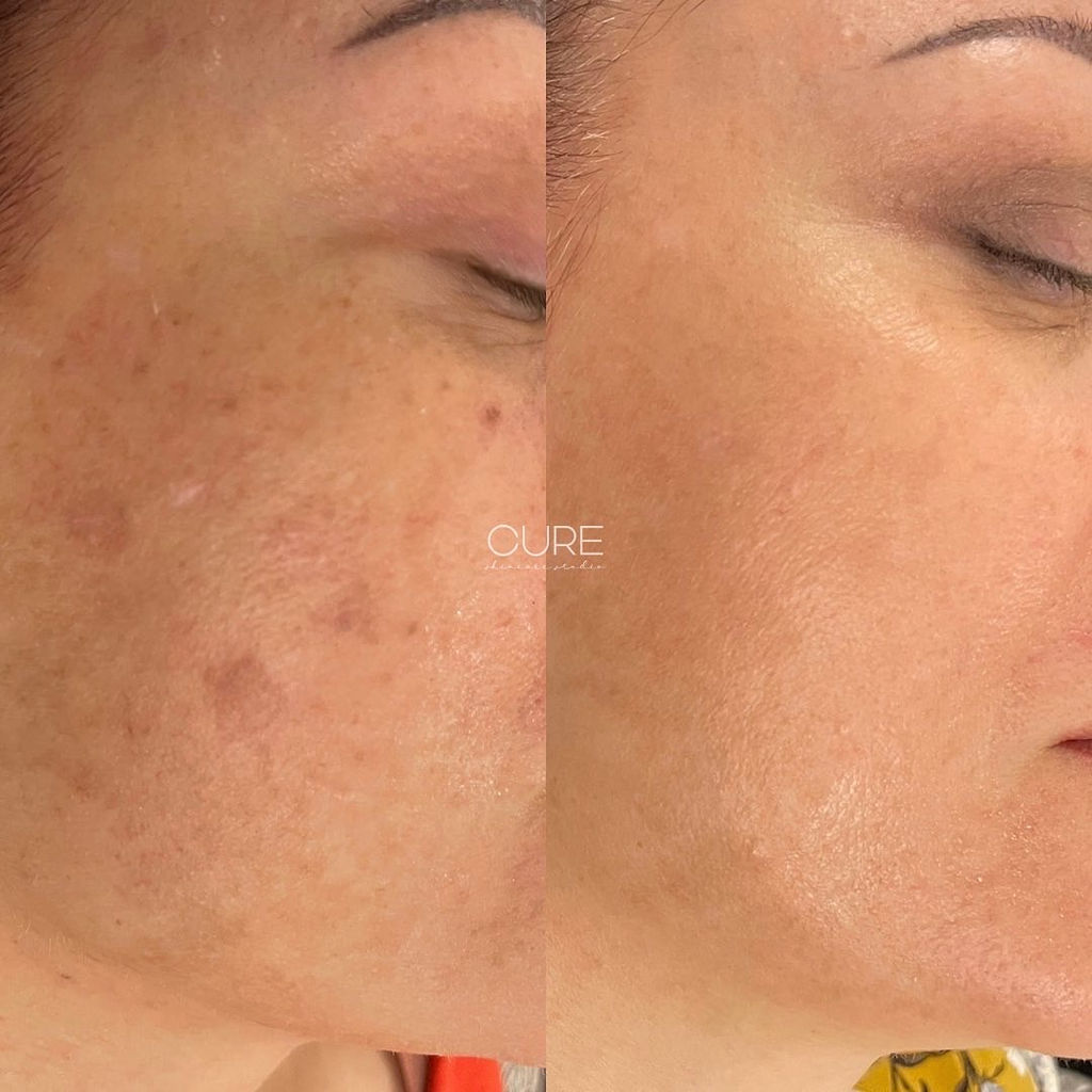 BBL Sun Damage Before and After