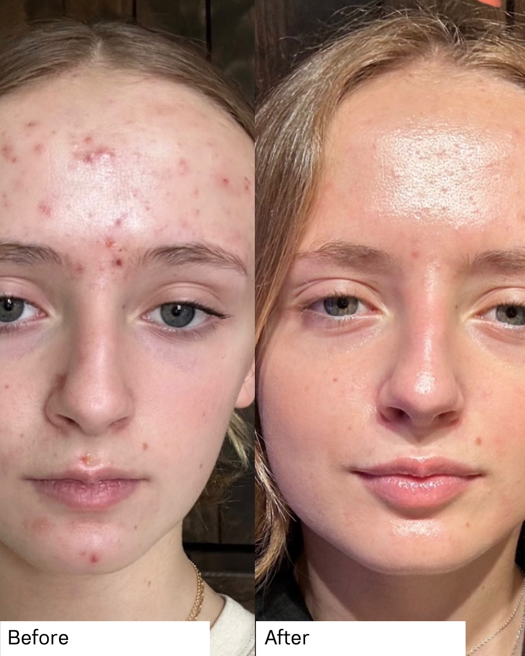 Teen Facial Acne Before and After