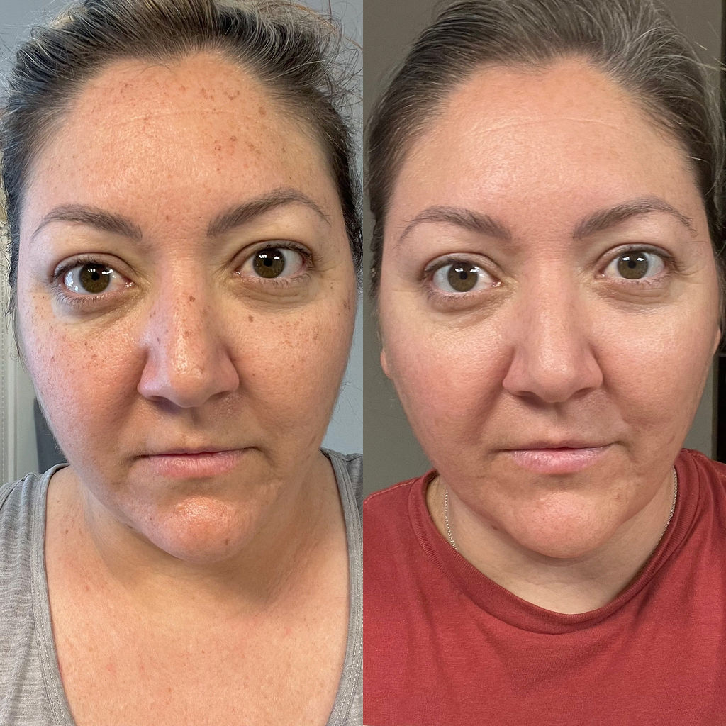 BBL Rosacea Side Profile