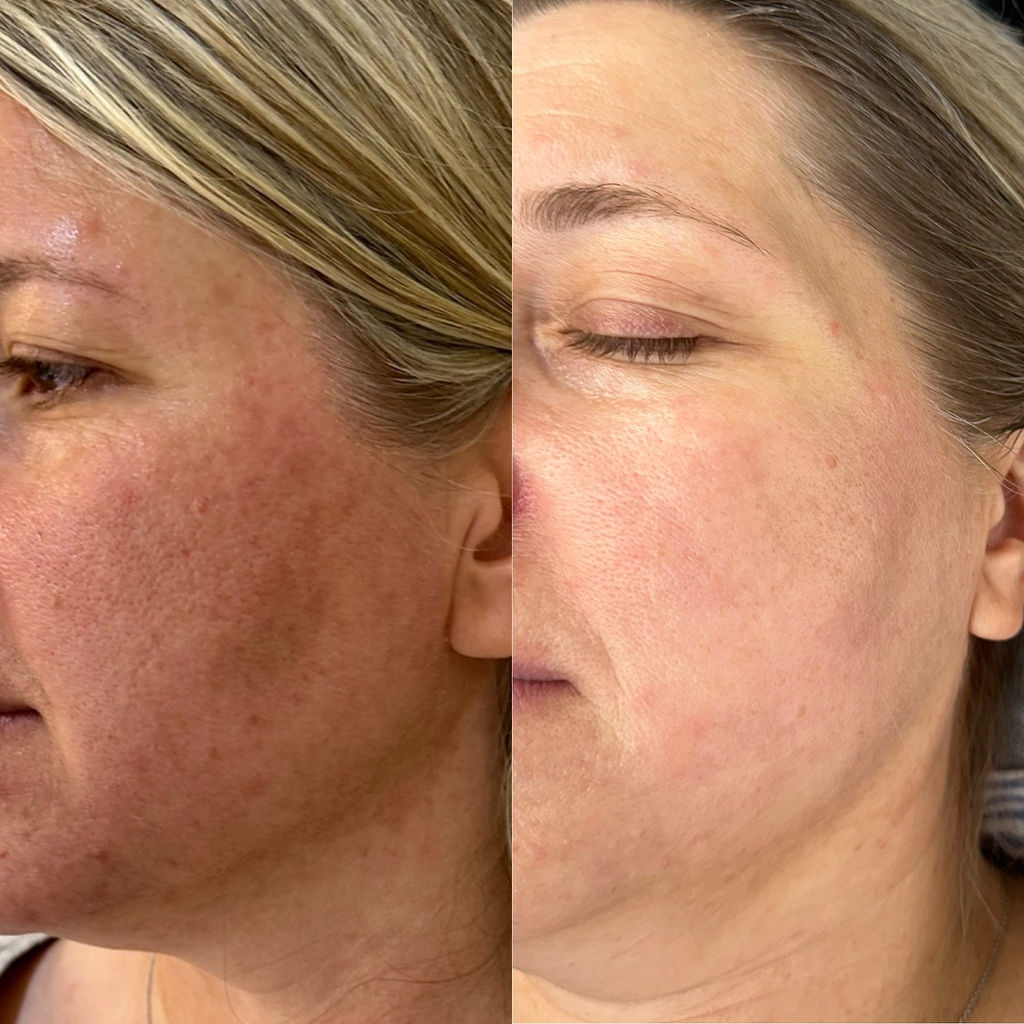 BBL Sun Damage Before and After
