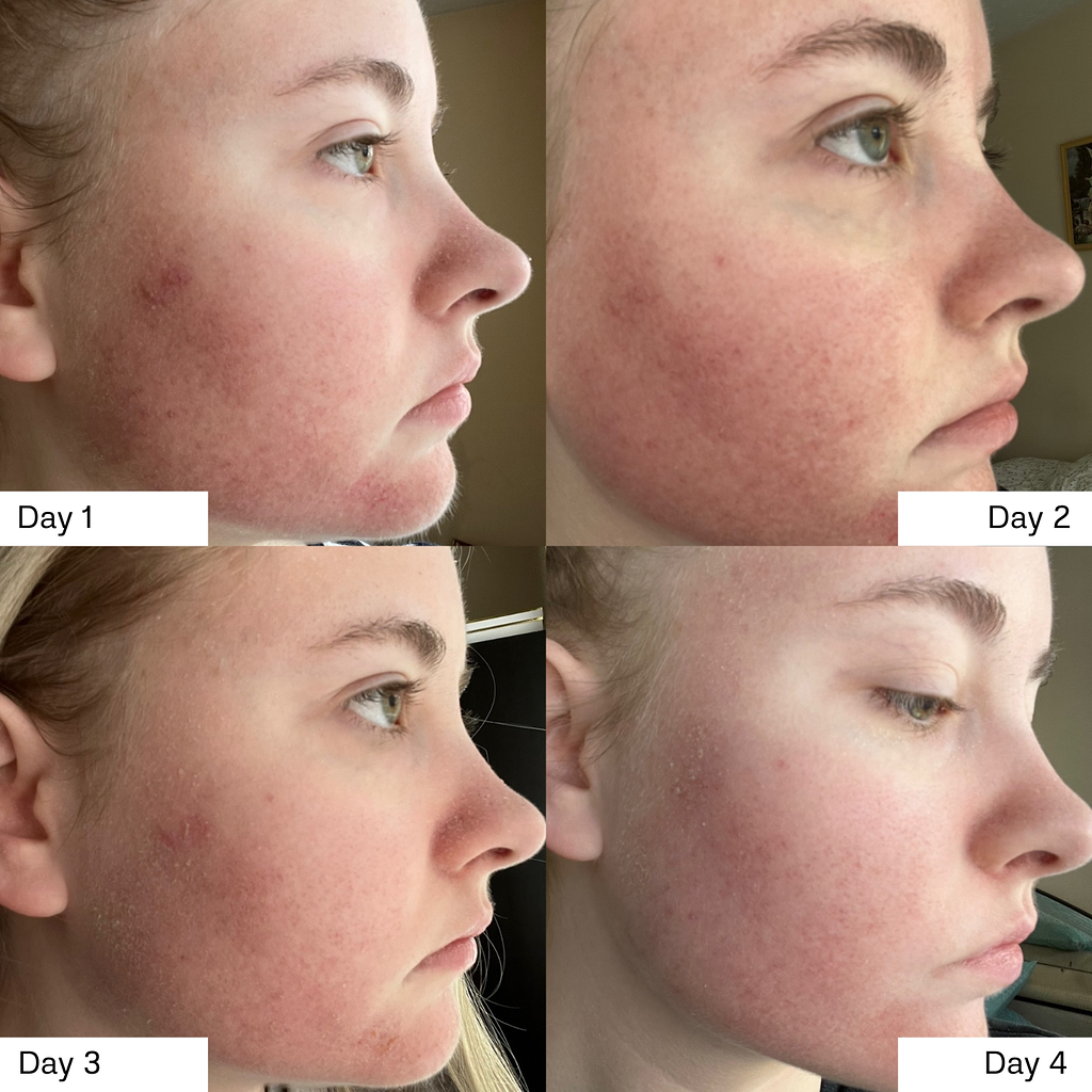 HALO Laser Healing Days 1-4
