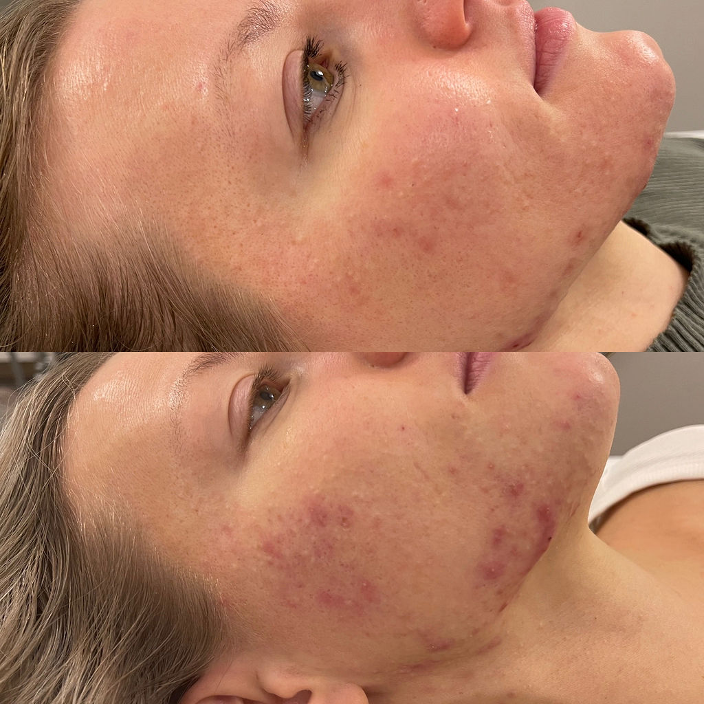 Skin Clarity Before and After Microneedling