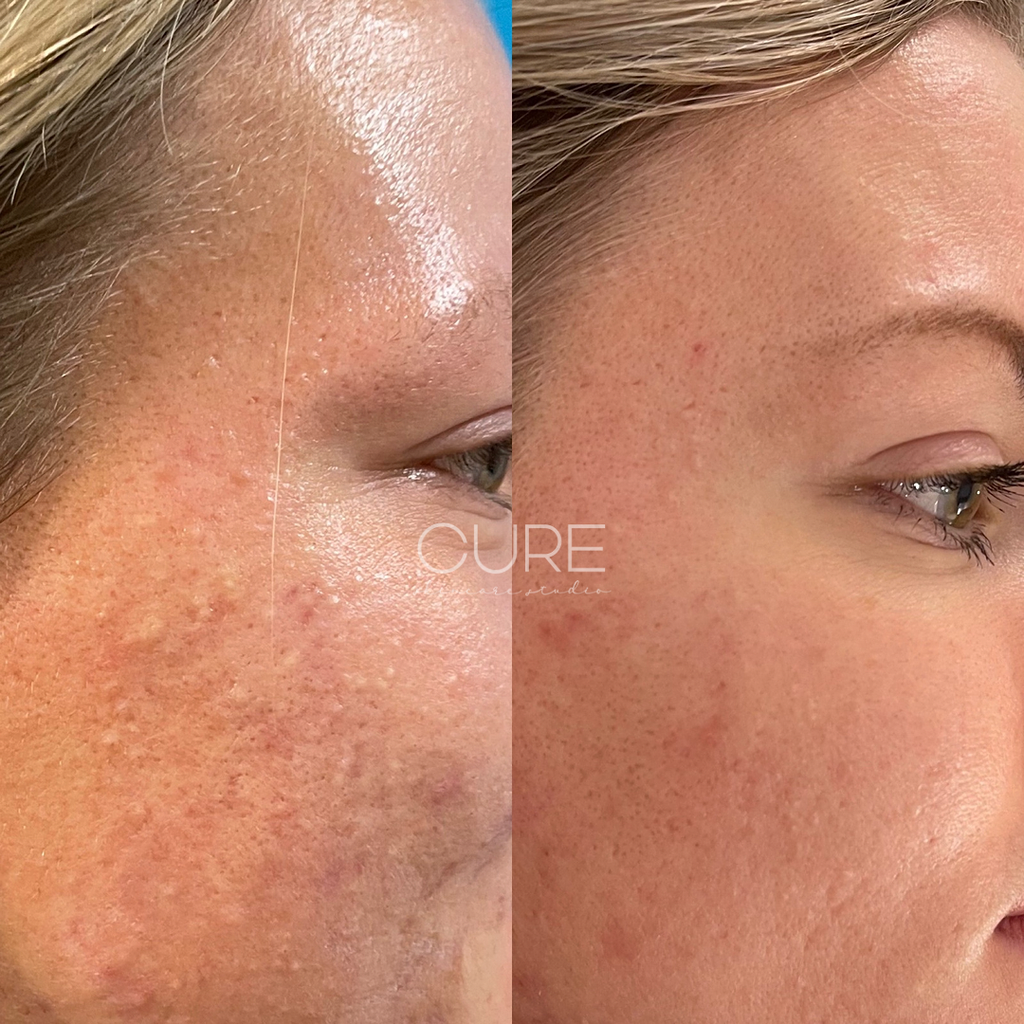 Acne Scarring Improvement Before and After Microneedling