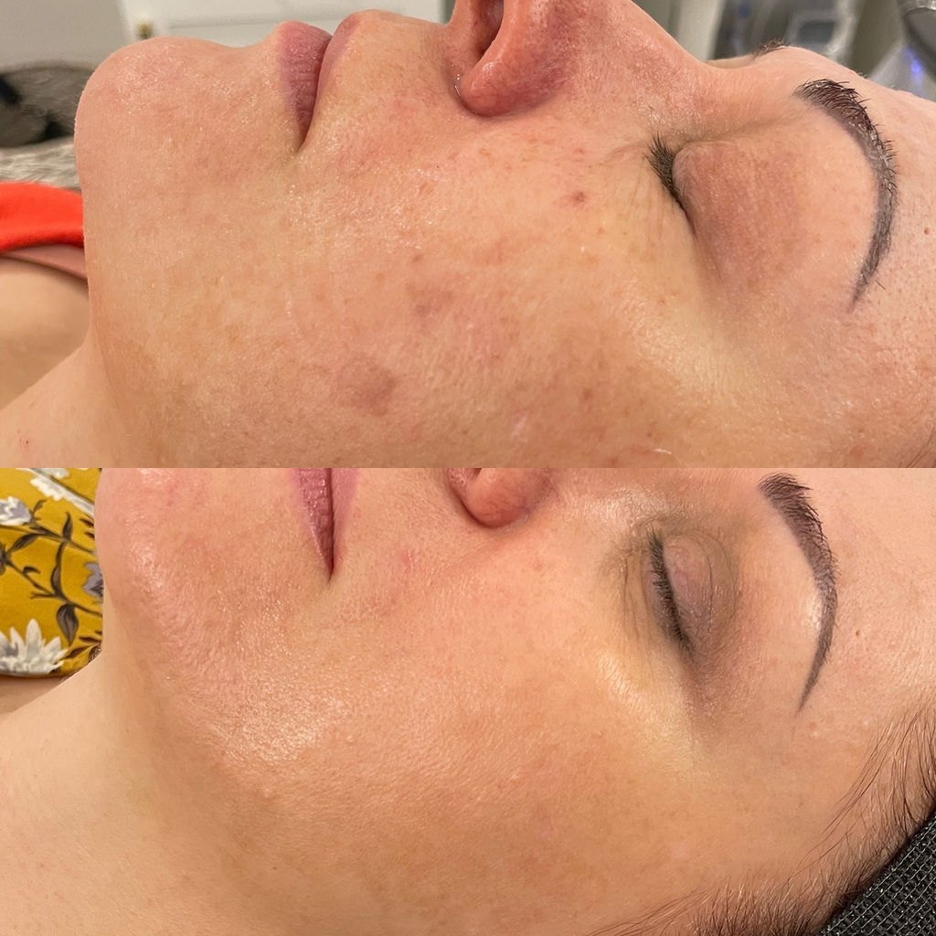 BBL Redness and Skin Tone Before and After
