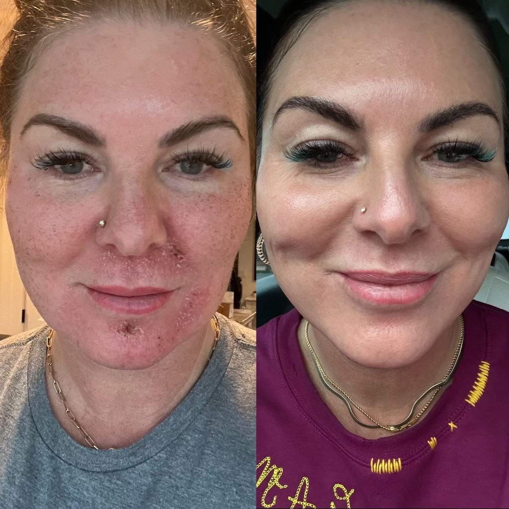HALO Skin Texture Before and After