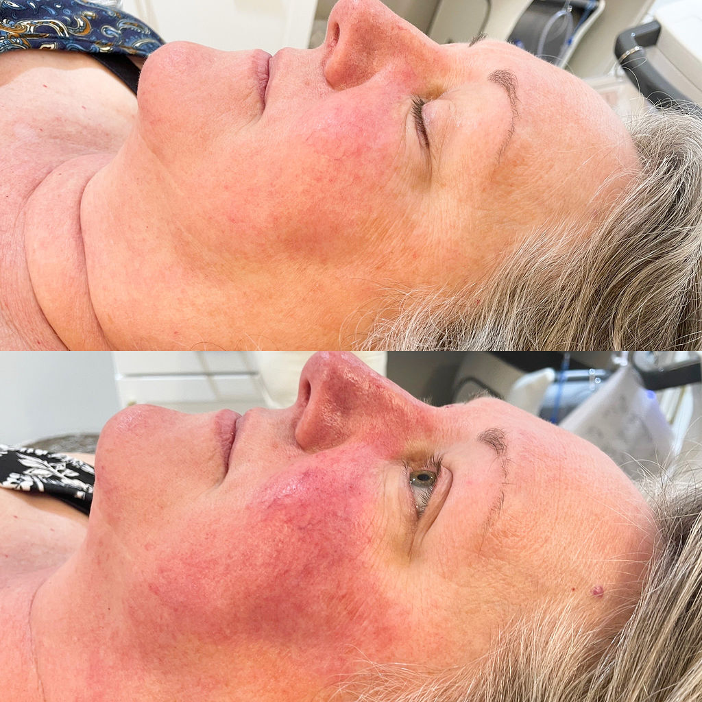 BBL Rosacea Before and After
