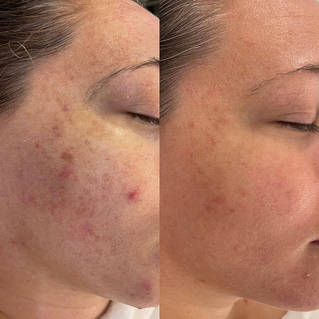 Brown Spots and Texture Before and After Microneedling