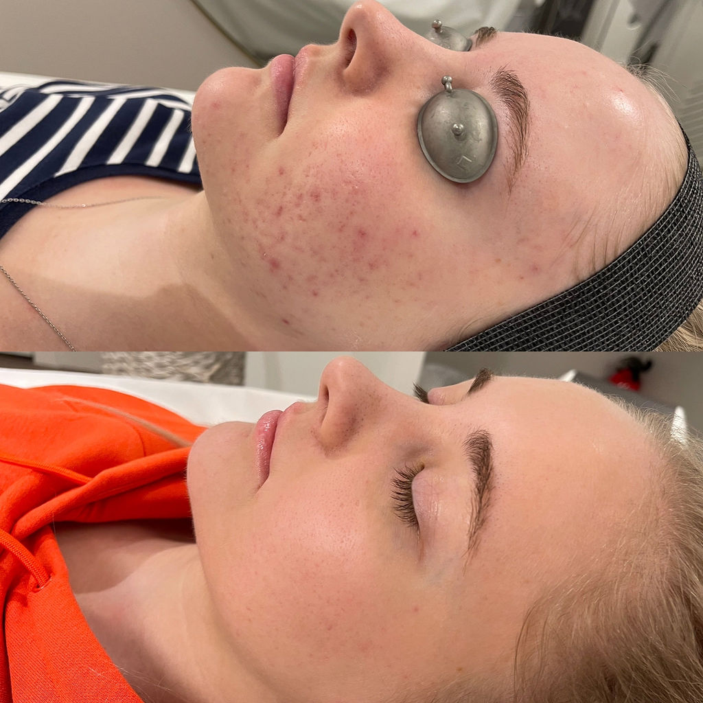 HALO Customized Treatment Before and After