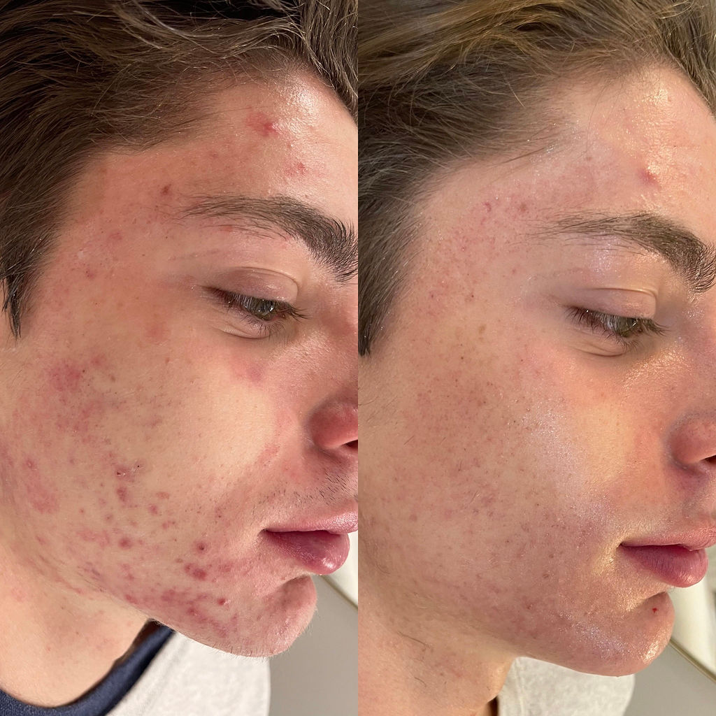 Acne Clearing Before and After Microneedling
