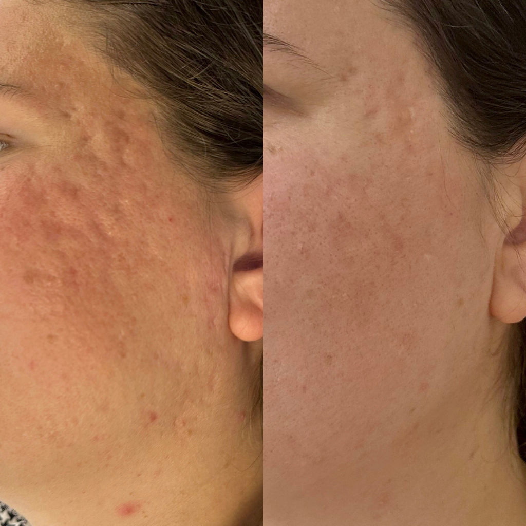 Ice Pick Acne Scarring Before and After
