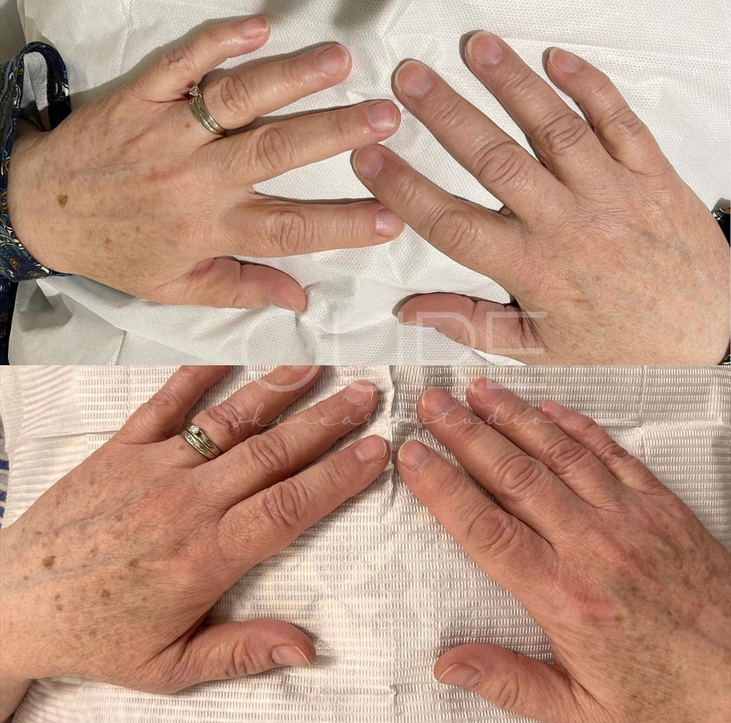 BBL Sun Spots on Hands Before and After