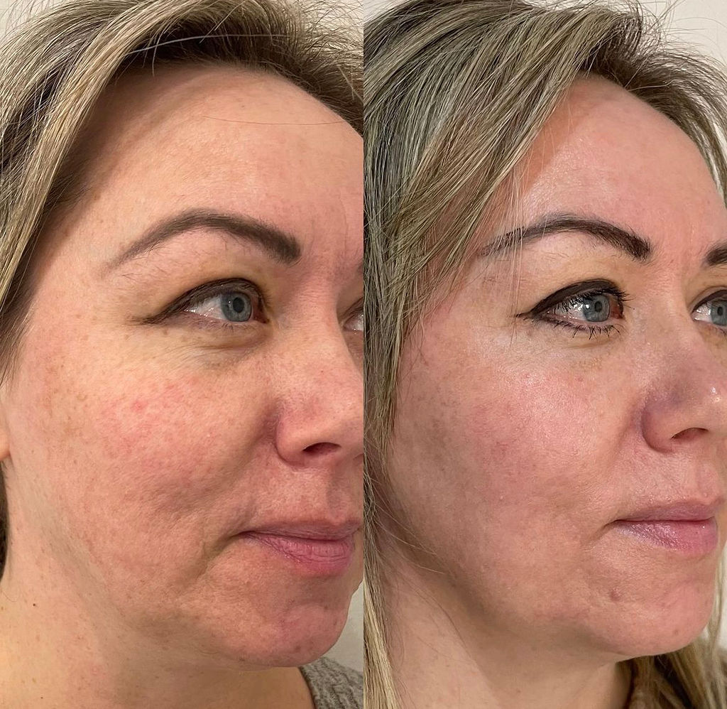 Skin Tone and Texture Before and After