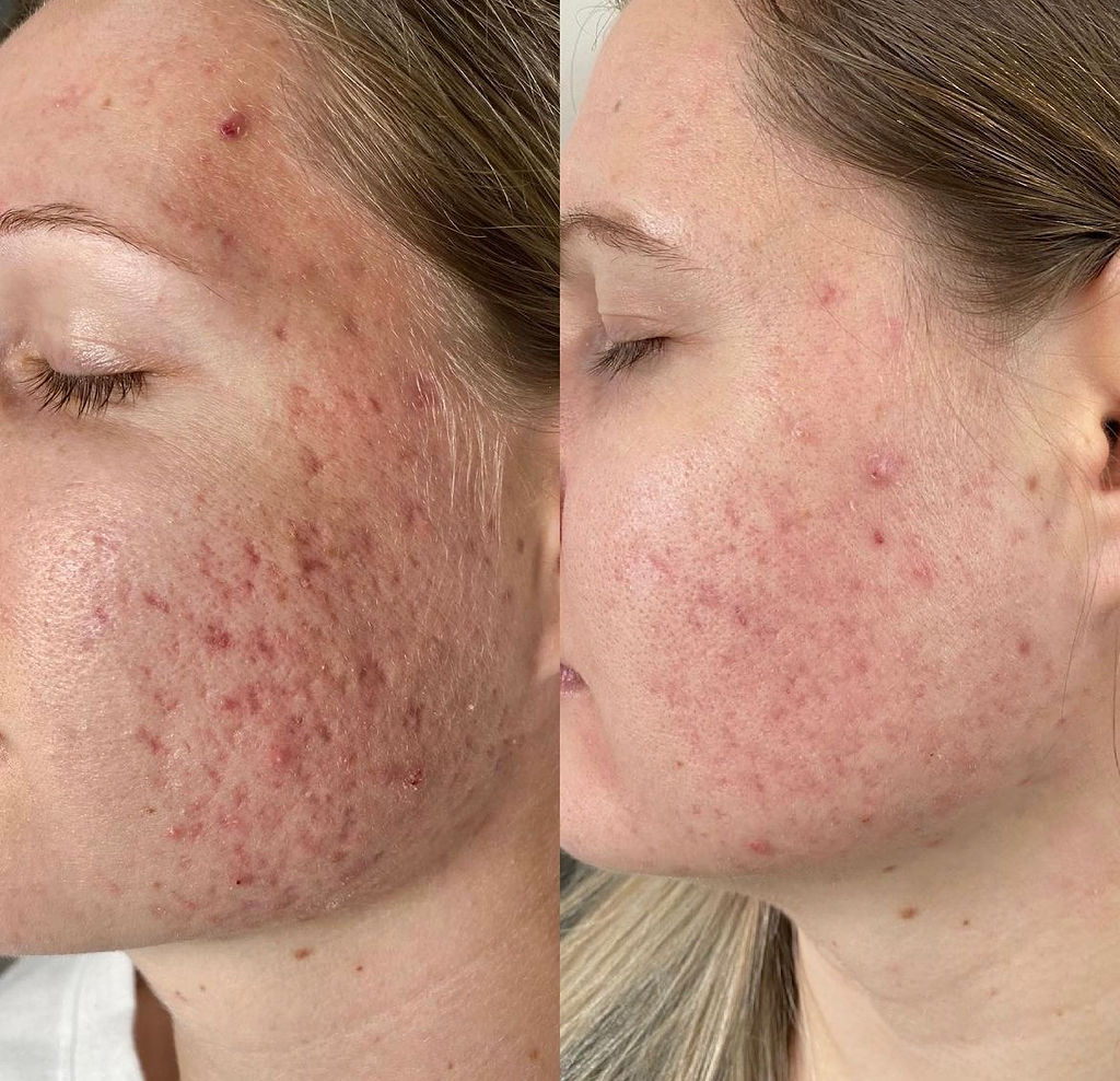 Acne and Texture Improvement Before and After