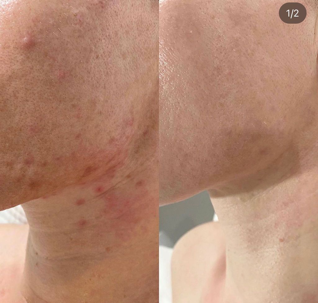 Neck and Jawline Before and After Microneedling