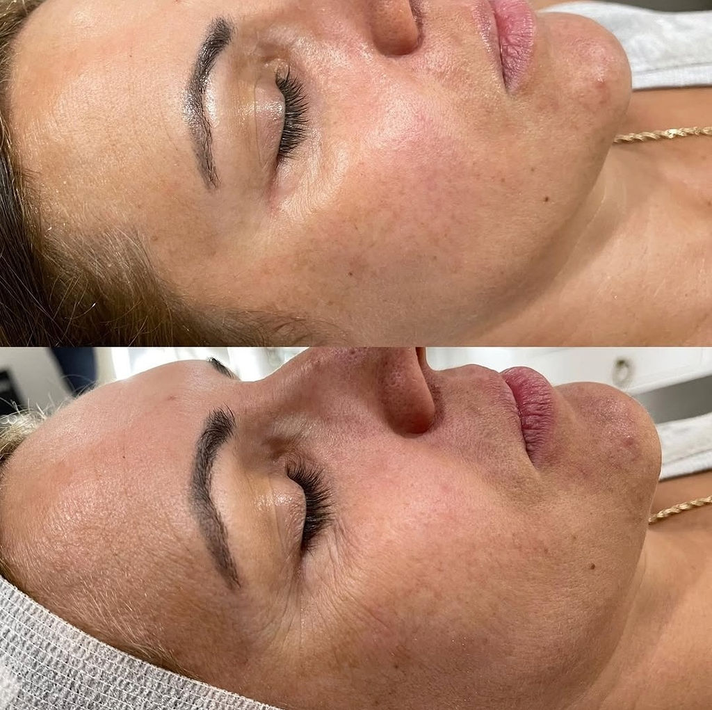 DiamondGlow Facial Before and After